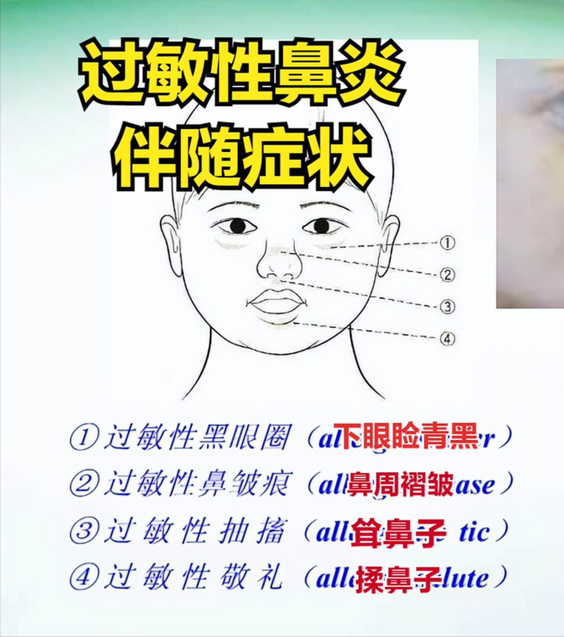 儿童过敏性鼻炎的四大症状分别是鼻痒,鼻塞,打喷嚏,流鼻涕,如果孩子在