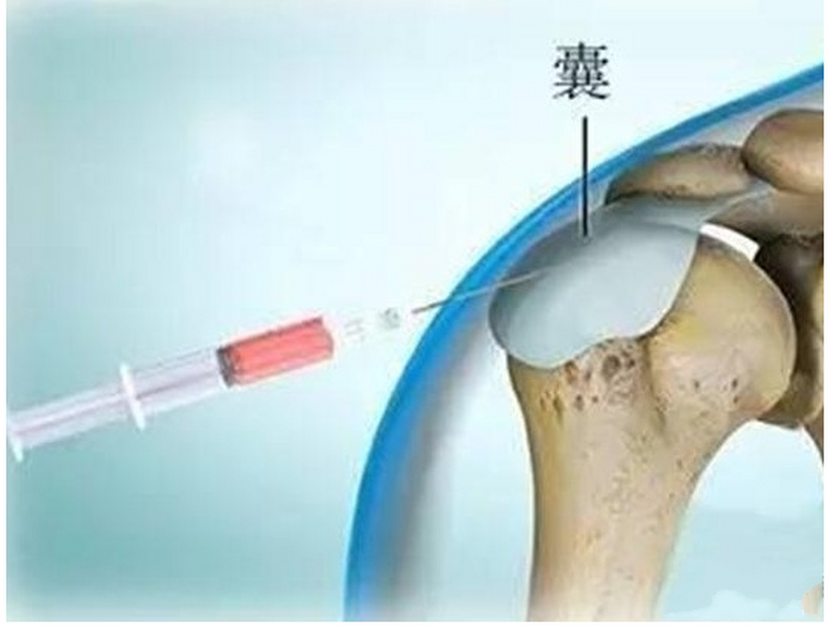 髋关节腔注射图片