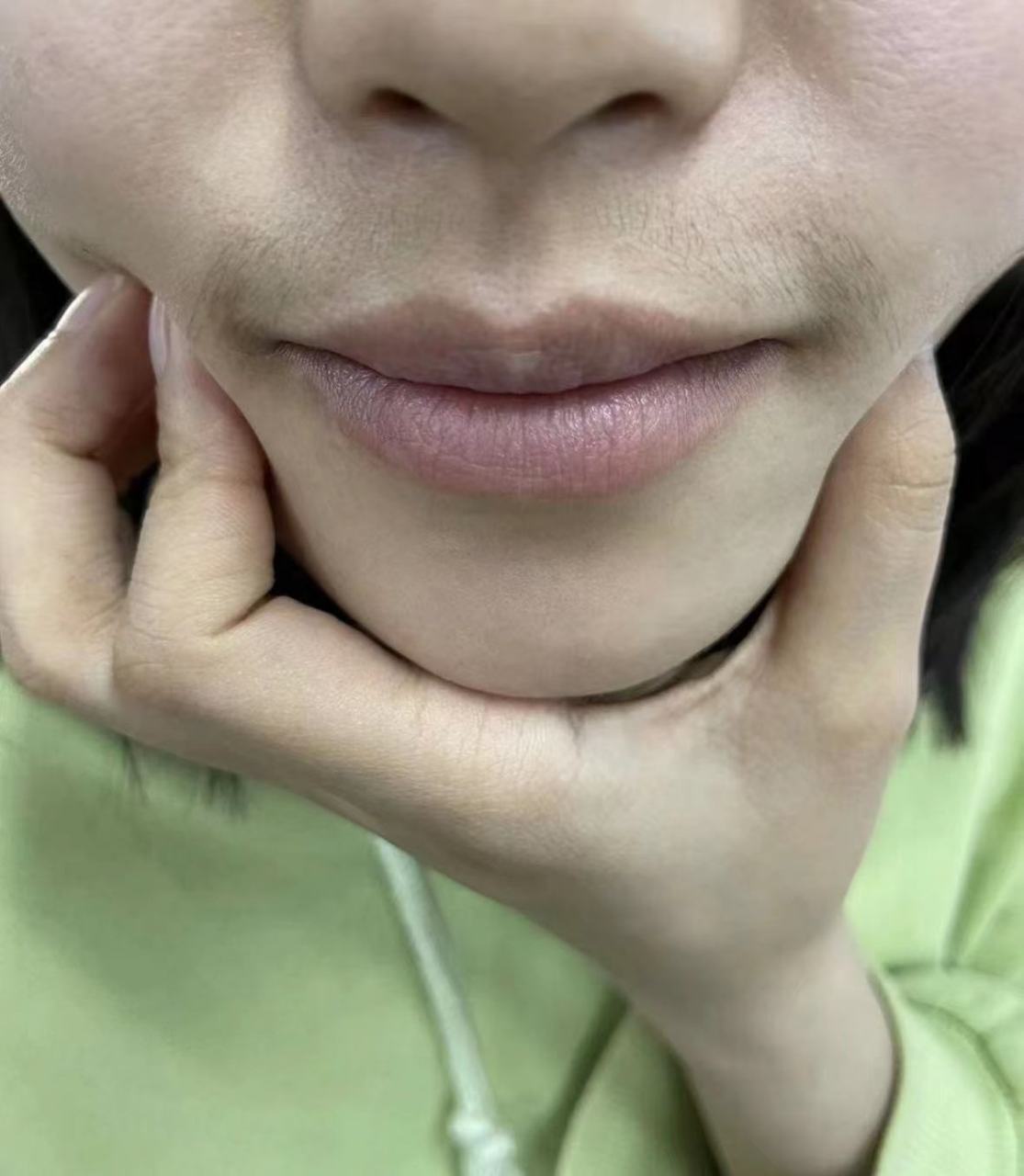 唇毛怎么去除永久女生 #医美科普挑战赛#  脱唇毛是很多女性在美容