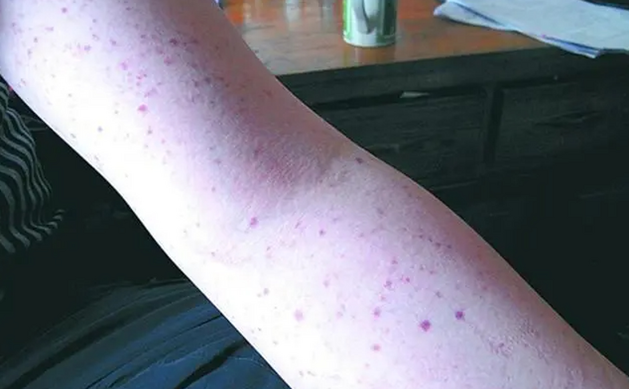 大家好,我是血液科肖医生[爱你]~血小板减少性紫癜可以自愈吗?