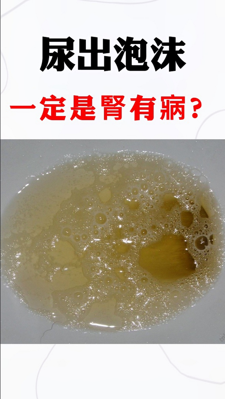 尿里有泡沫就一定是肾病?误区!教你一招分辨!
