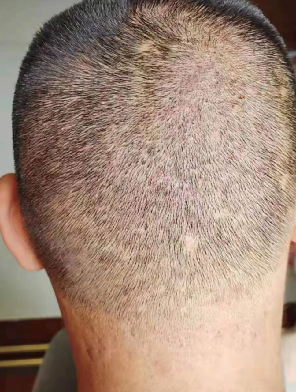 小伙毛囊炎反复5年,满头长红肿疙瘩,用这个方法2个月拿下!