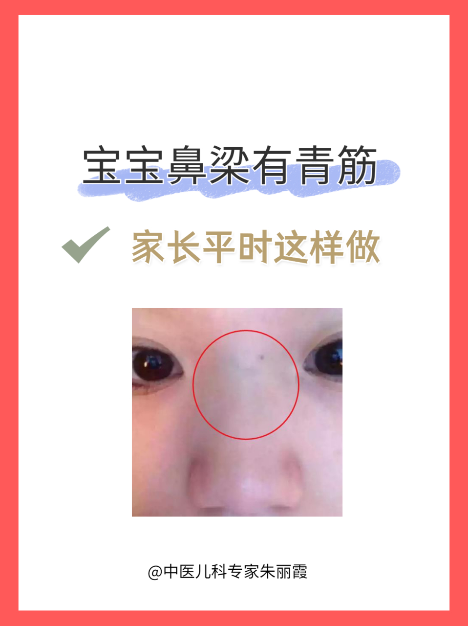 宝宝鼻梁有青筋,家长平时要这样做!