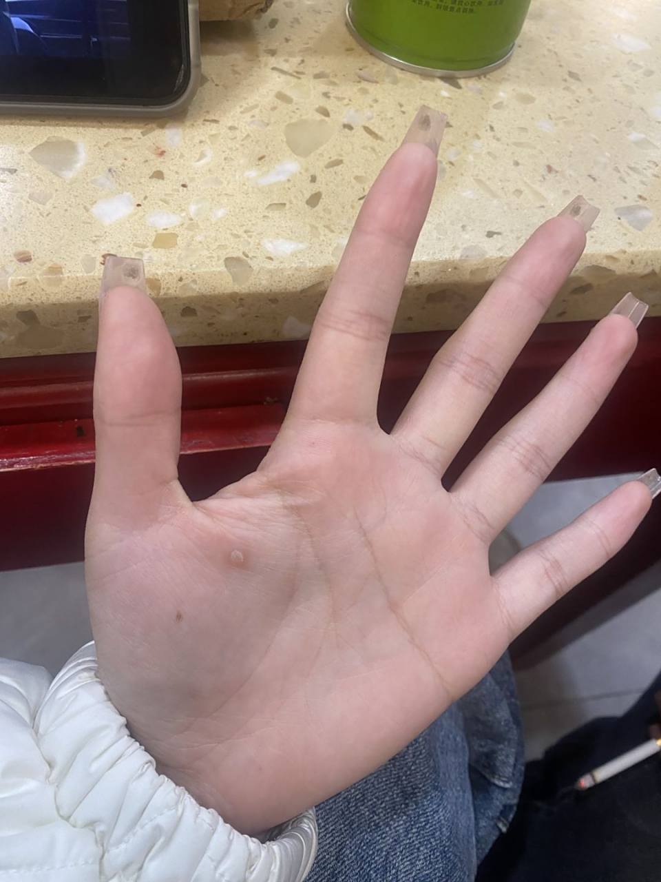 朋友们 帮我看看我对象手上这个咋回事  是不是鸡眼 感觉不像 有点像