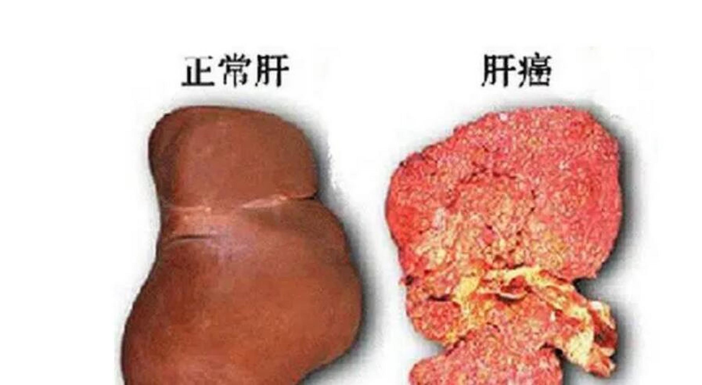 黄先生腹部疼痛2周不见好,在当地医院检查查出肝肿瘤,大小在8公分了