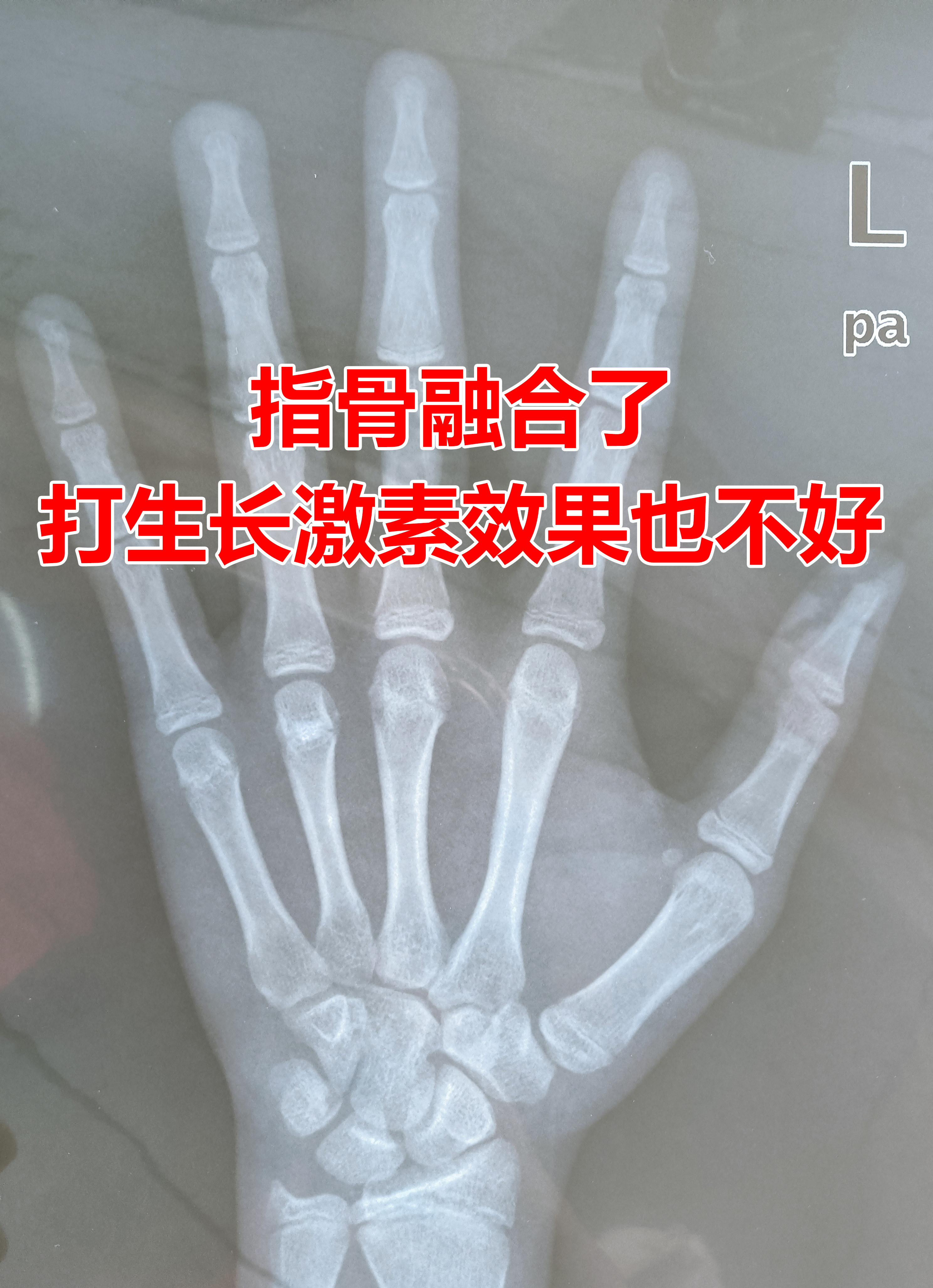 上个月接诊了一个孩子小姑娘骨龄已经评到13岁了指骨都已经融核了