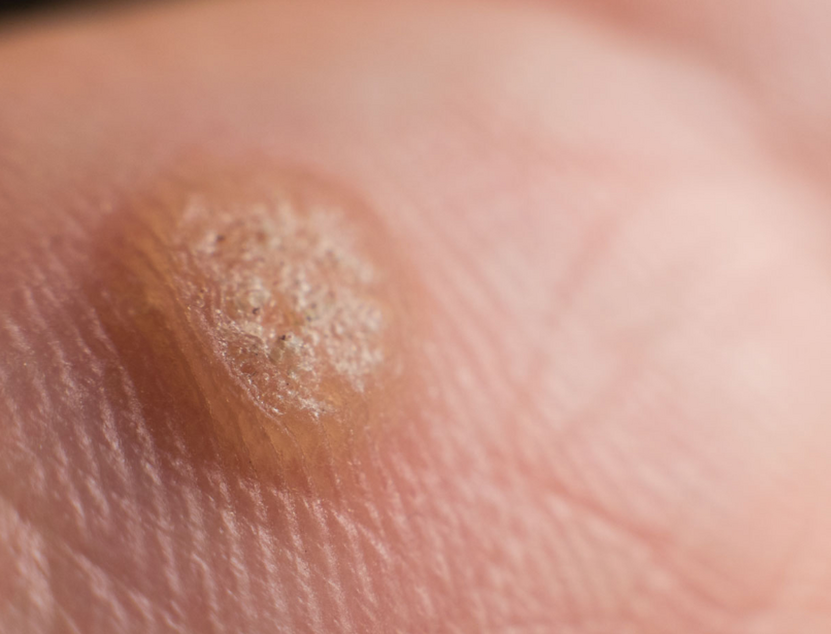 "菜花状的东西长在身上,一定就是尖锐湿疣吗?