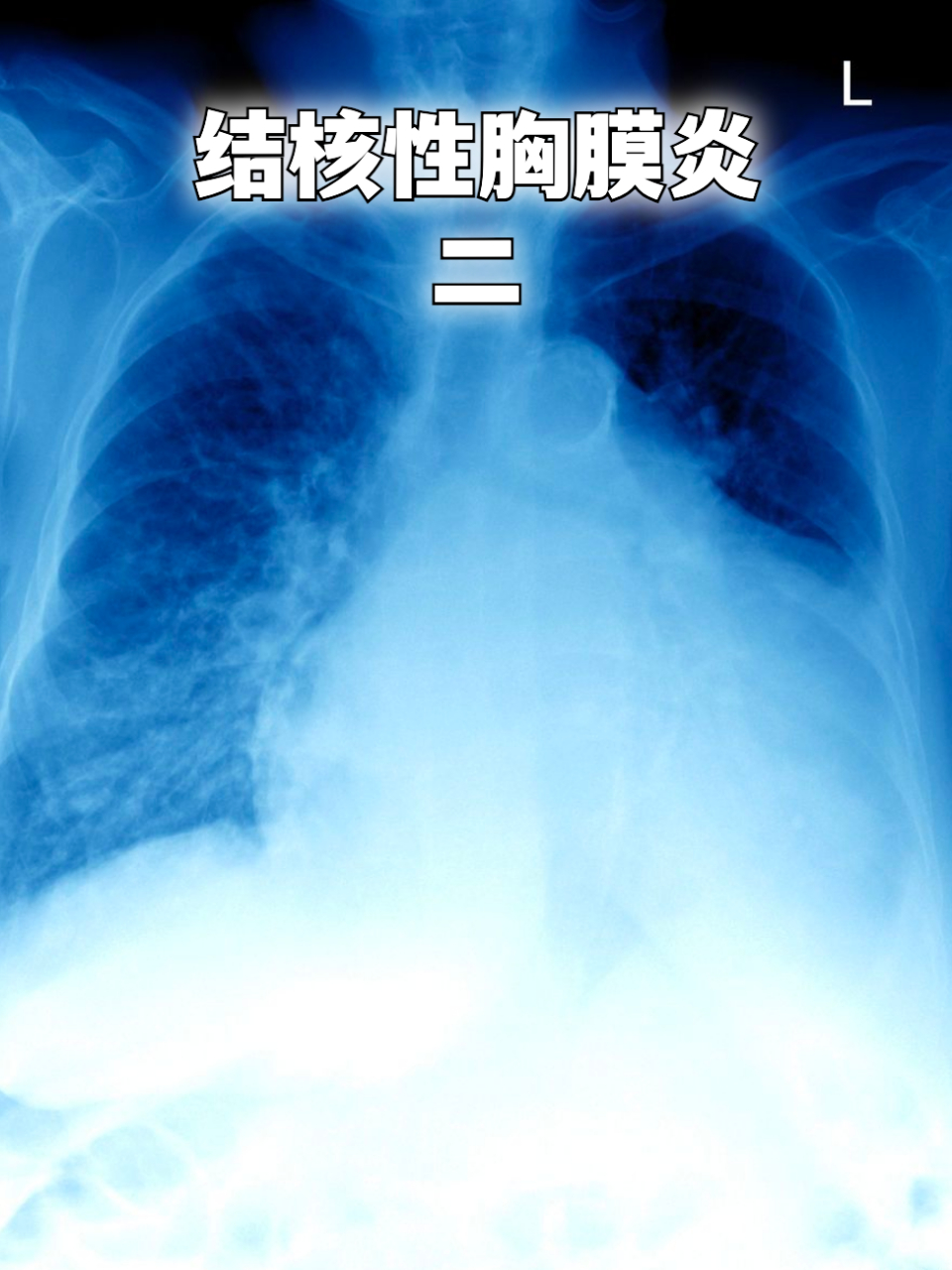 结核性胸膜炎二 #胸膜炎# 我是用的胸腔闭式引流  第一天胸水引流: 医
