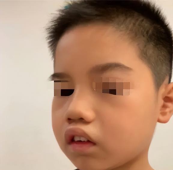 孩子腺样体肥大需警惕!腺.@中医儿科郑军教授的动态