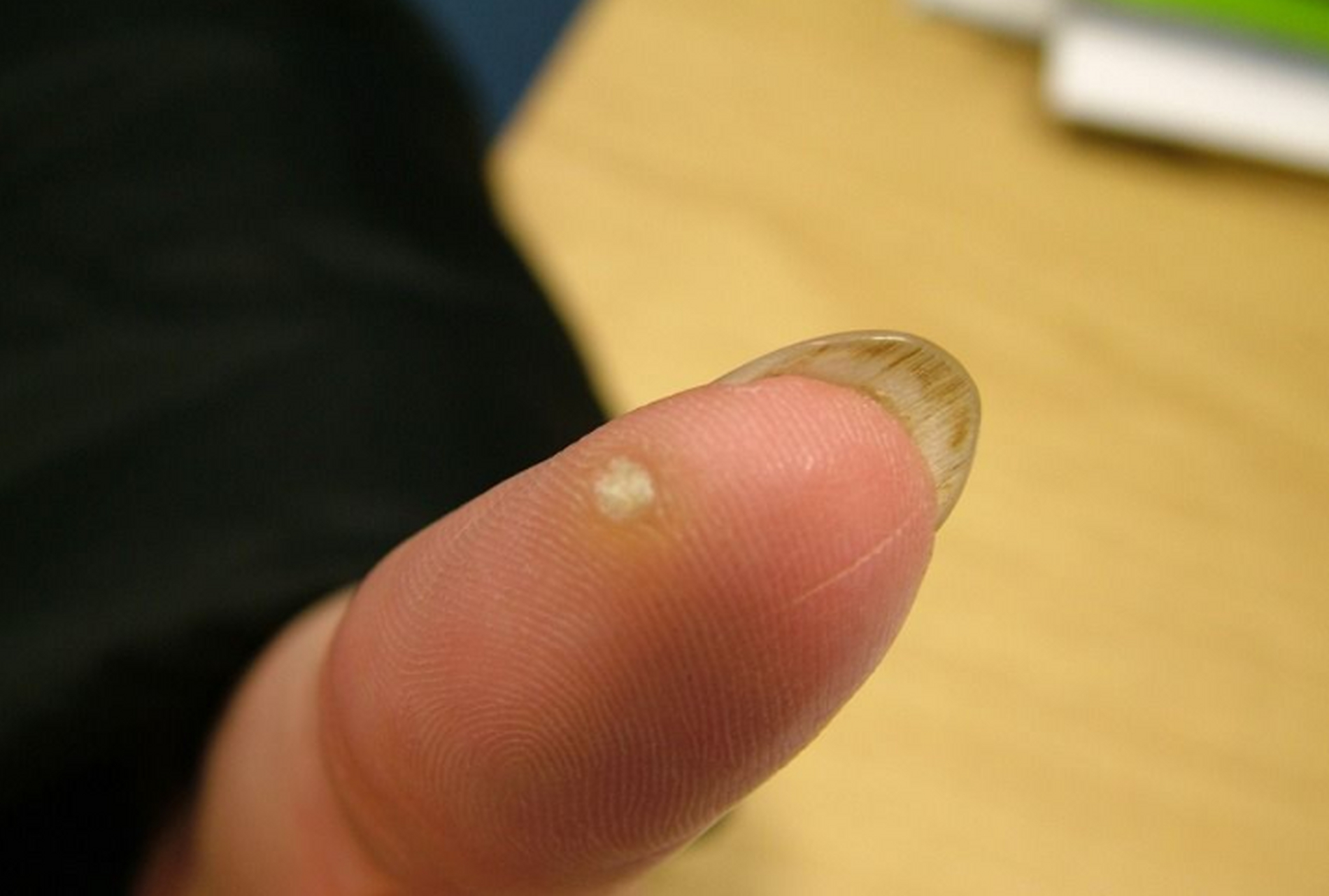 寻常疣,也叫手指疣,是一种常见的病毒感染所致皮肤病.