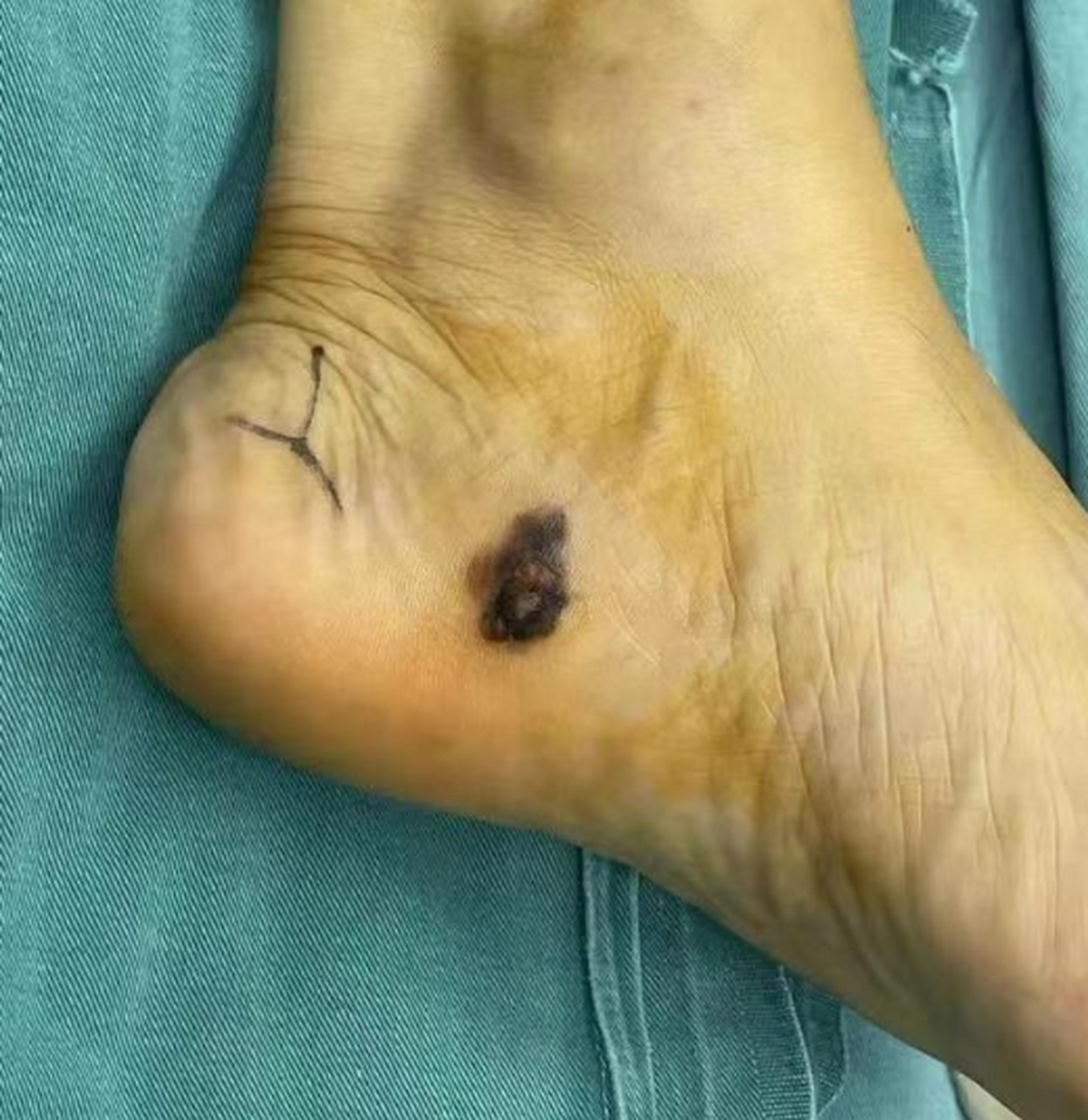 42岁的王叔,是一名工地工人,脚上长了个"鸡眼",刚开始不疼不痒,就没