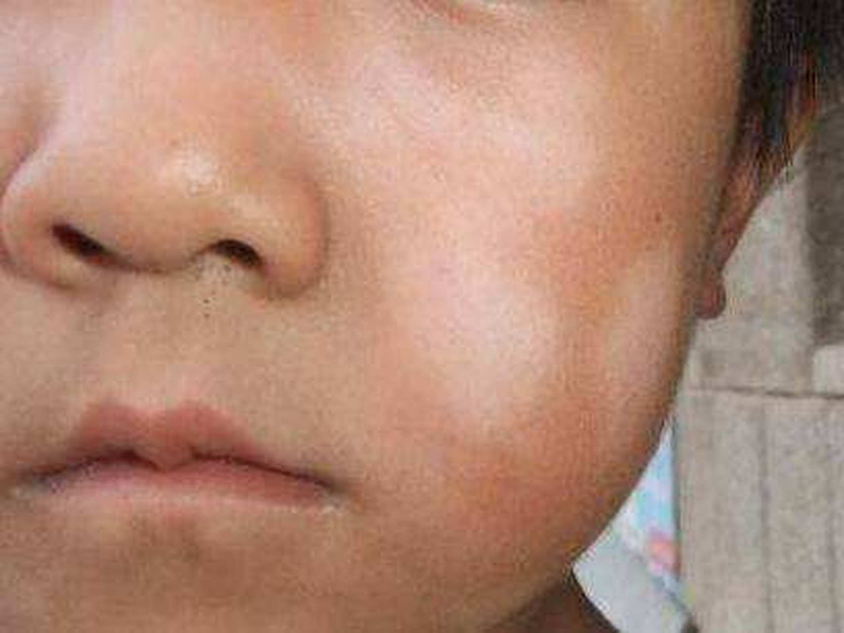 单纯糠疹##惠州皮肤医院# 单纯糠疹又称白色糠疹,链球菌性糠疹,中医