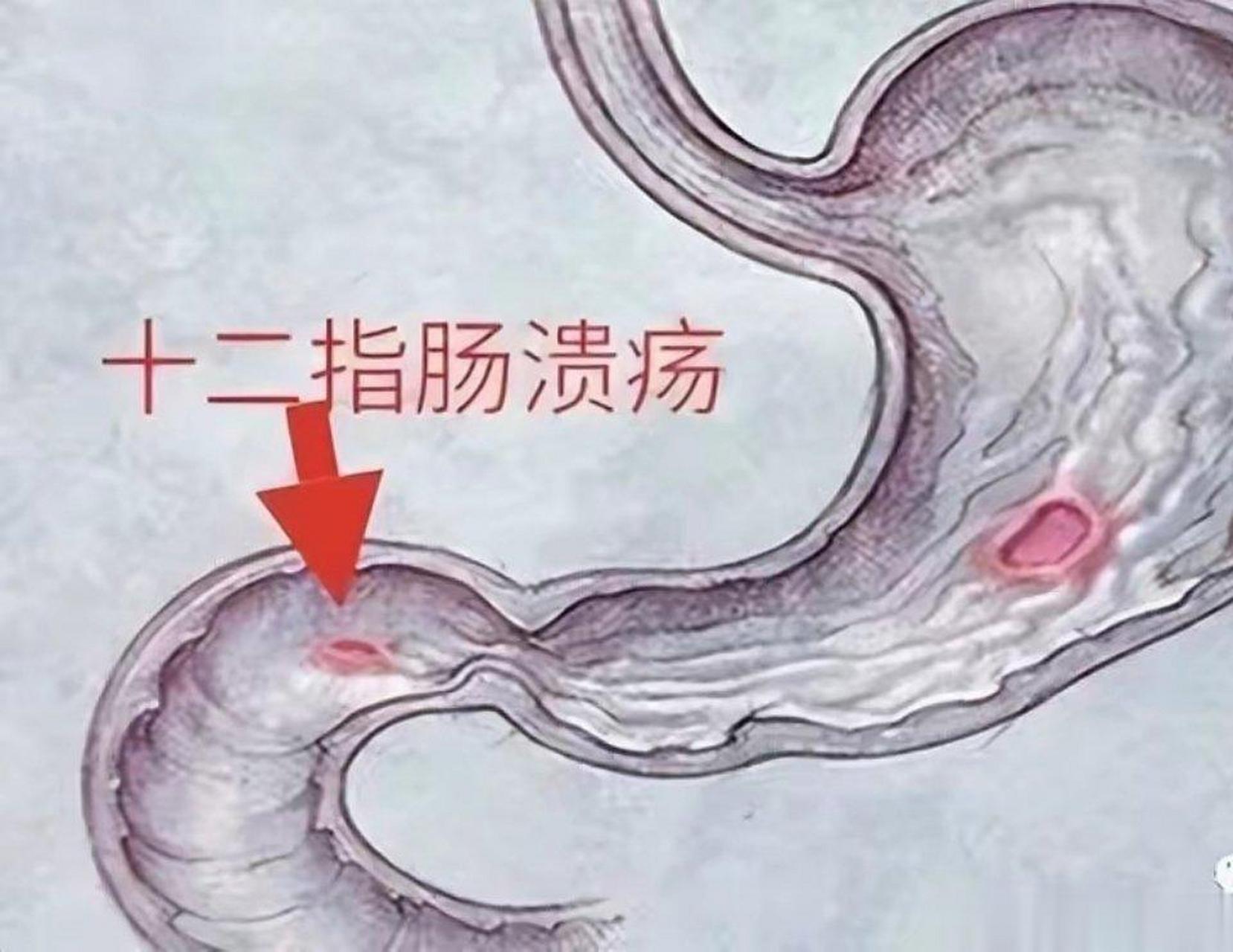 1,疼痛疼痛是十二指肠炎较为突出症状.