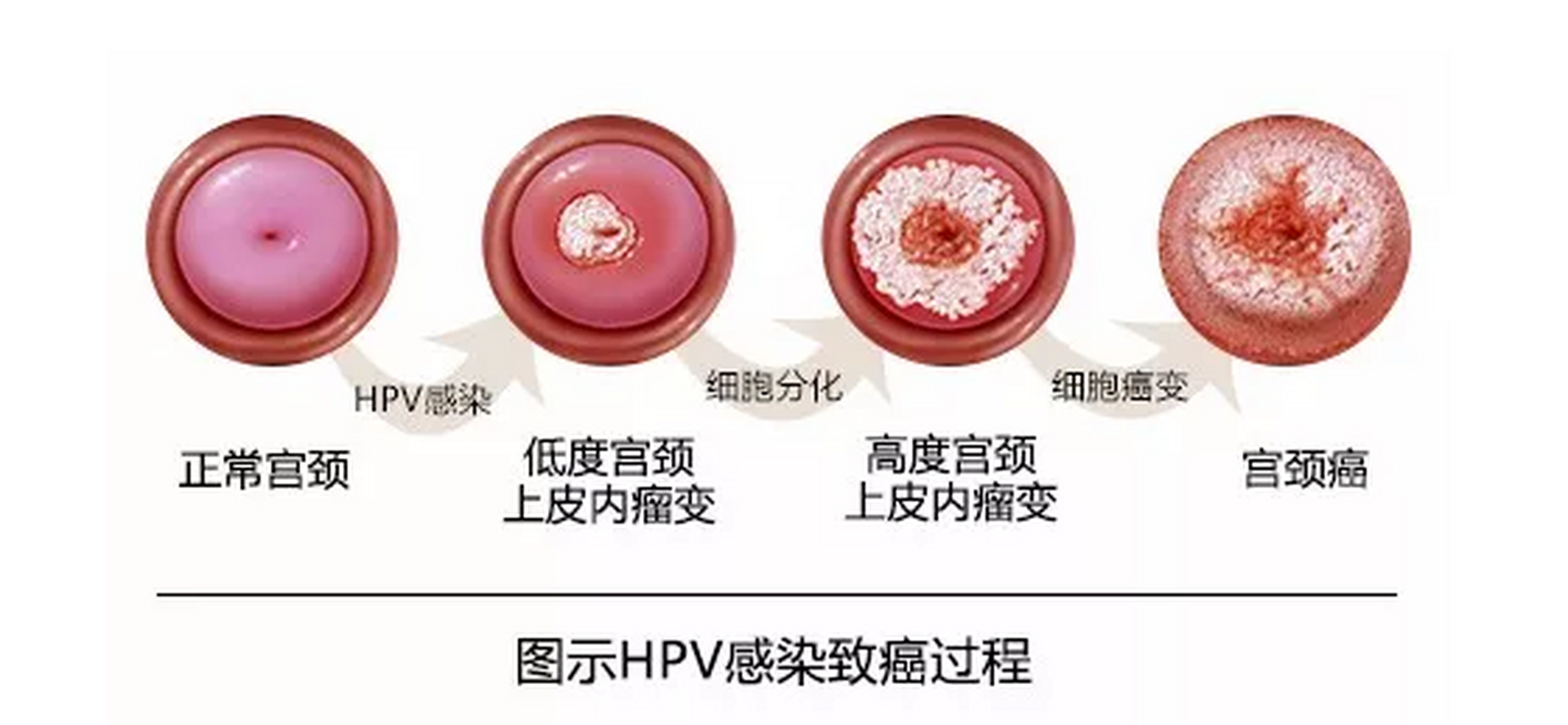 hpv感染先别划走,记好2点转阴不愁  【针对症状】 hpv感染,或伴有分泌