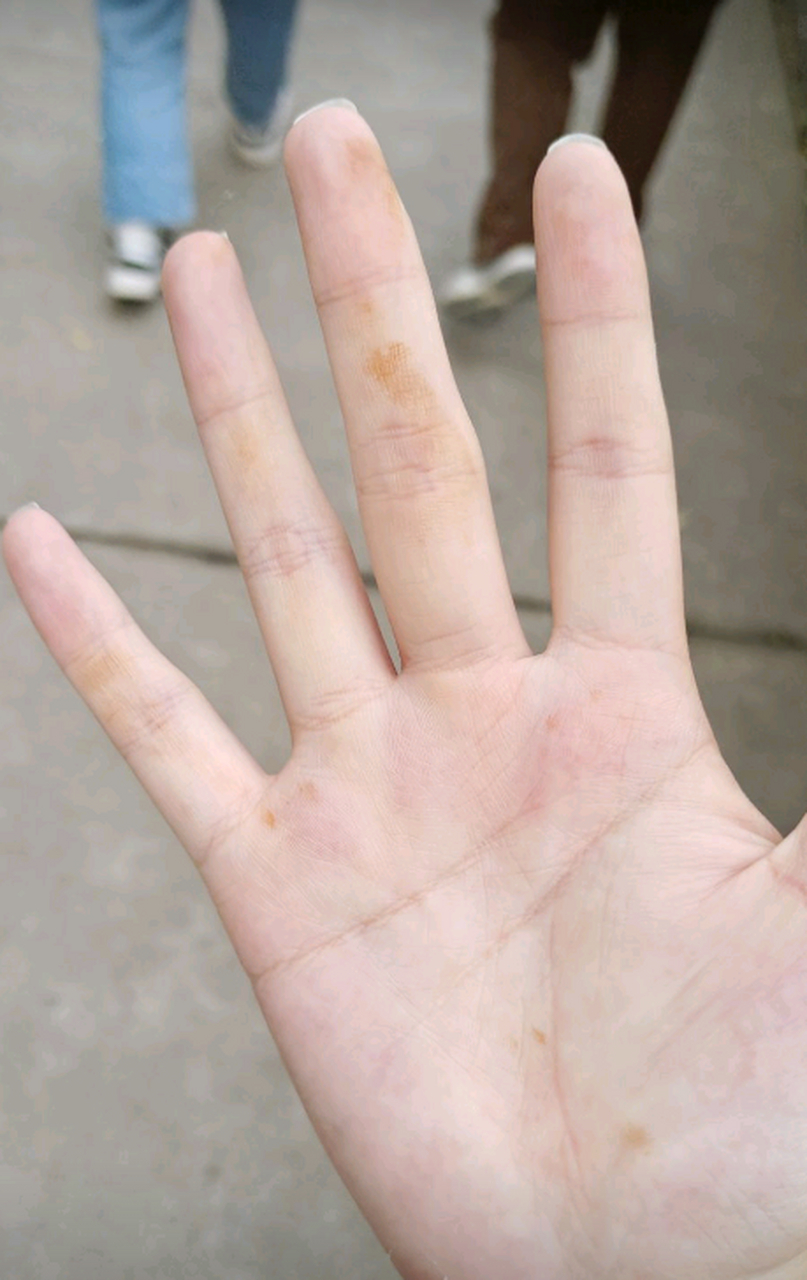 为什么一觉醒来,就发现手上发黄,也没拿什么东西啊