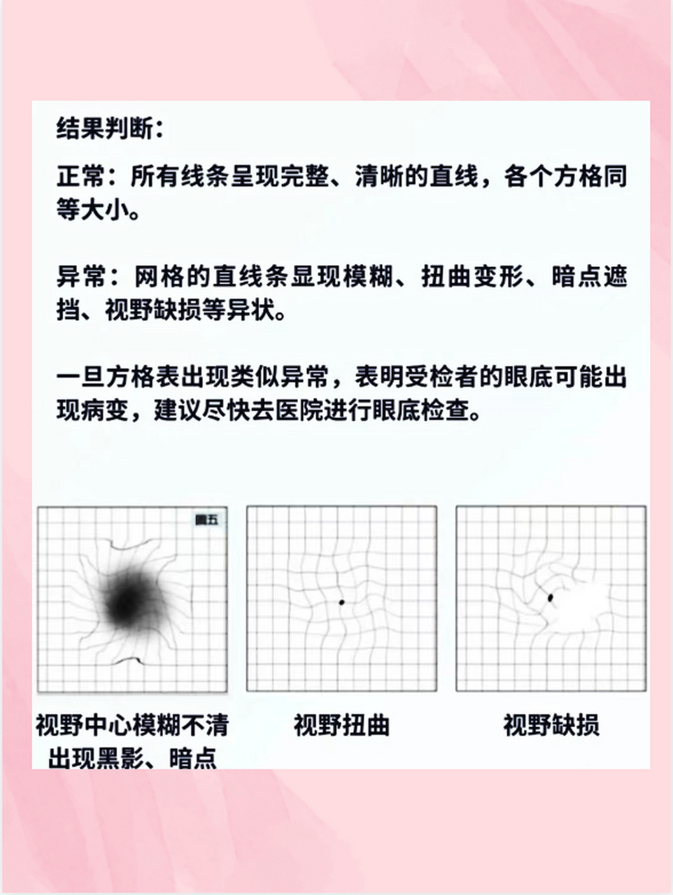 眼底自测图  如果您出现图二的症状可能是眼底黄斑区出现了问题,黄斑