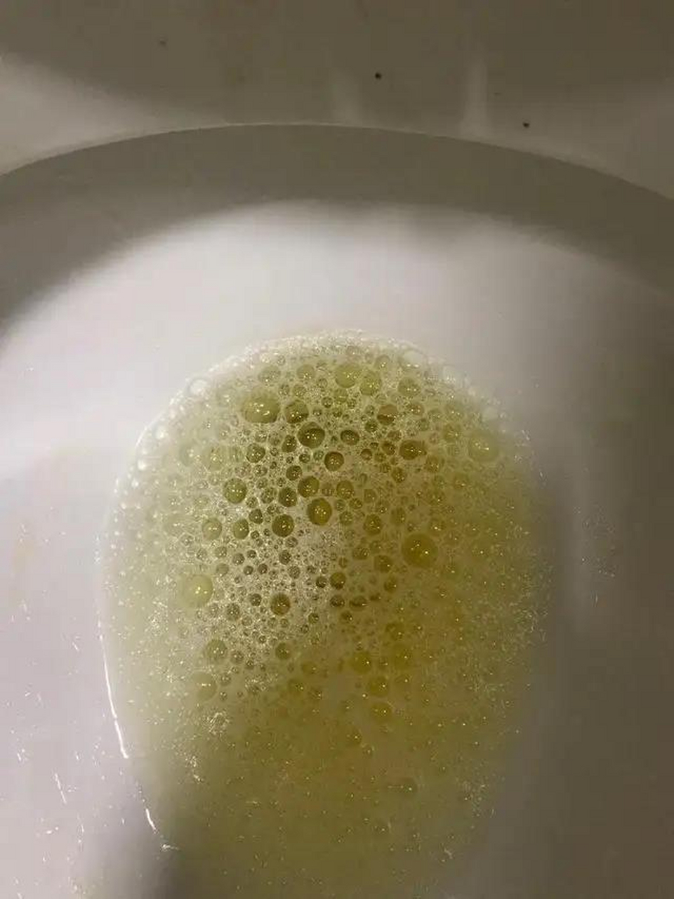 尿液就是肾脏健康的晴雨表,肾要是有问题,最先察觉应该是尿液  正常