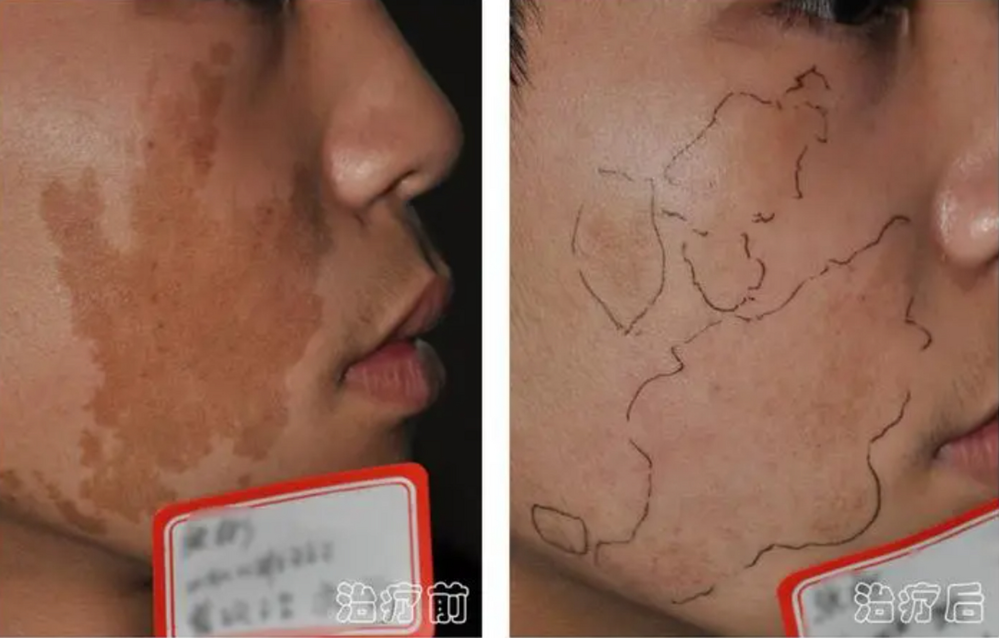 咖啡斑又称咖啡牛奶斑,是出生时即可发现的淡棕色的斑块.