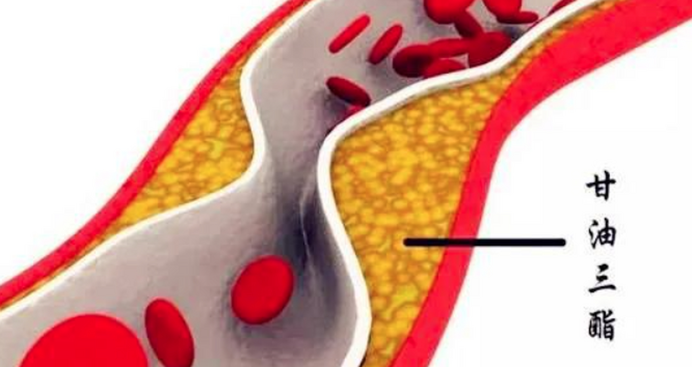甘油三酯高和血脂高是一回事吗?