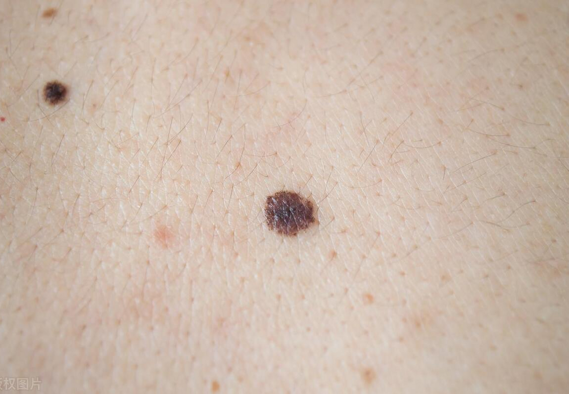 从肉眼判断,良性的色素痣往往是圆滚滚或者形状对称的,而恶性的色素痣