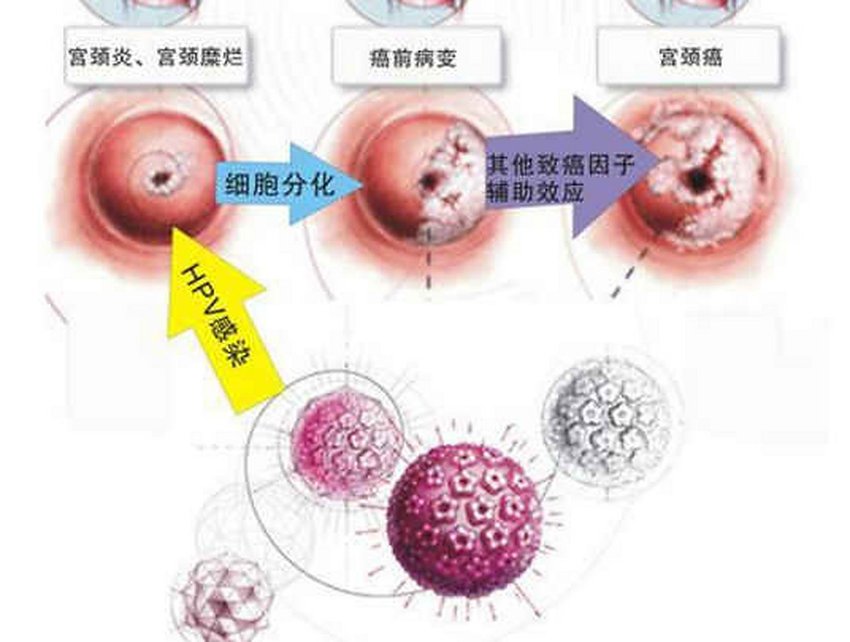 上厕所时多看一眼,内裤上若有2个异常,八成是hpv感染了  1,分泌物异常