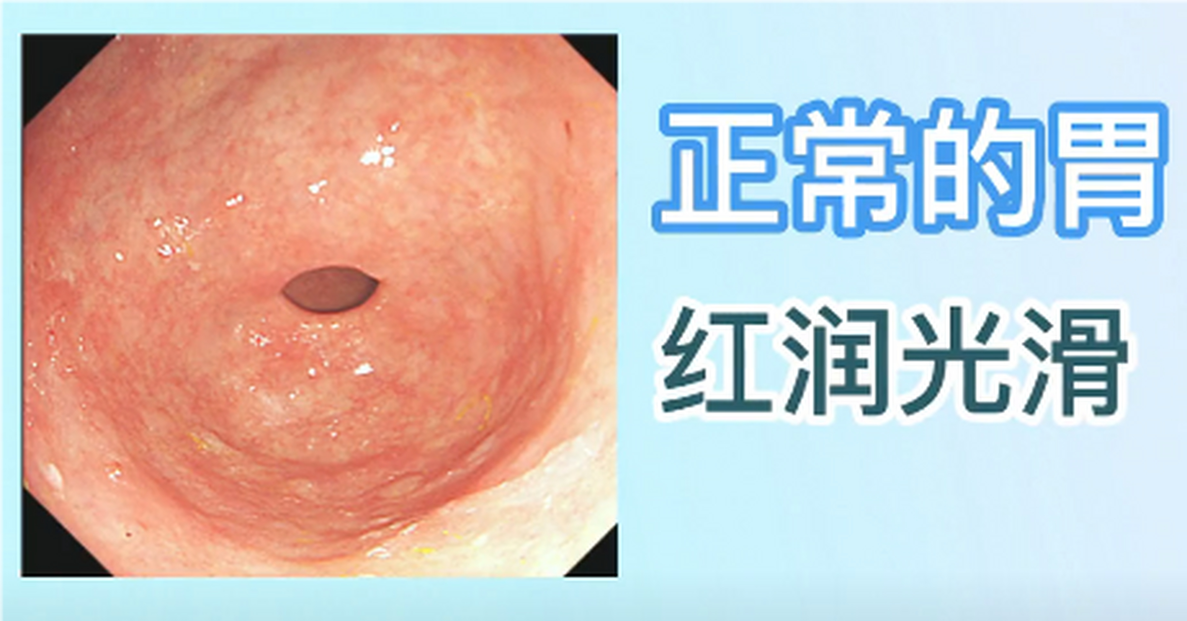 做过胃镜的人应该都看过这样的图片,胃镜下不同疾病胃的形态  找找