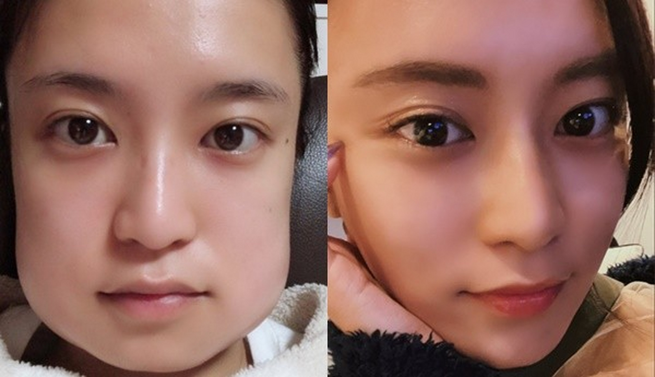 明星晒幸福# 【日女星拔2颗智齿,鹅蛋脸肿成国字脸】现年27岁的日本