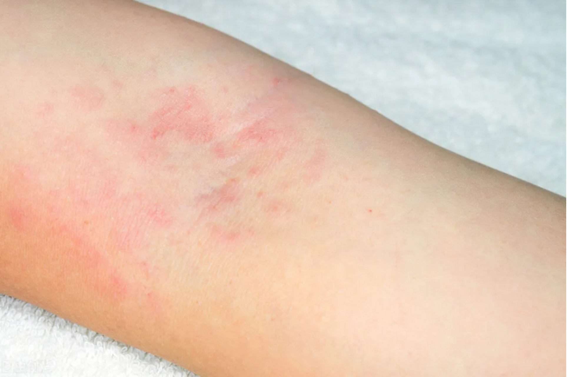 出现皮肤过敏的症状,要注意这几件事 皮肤过敏的患者一般都是受到各种
