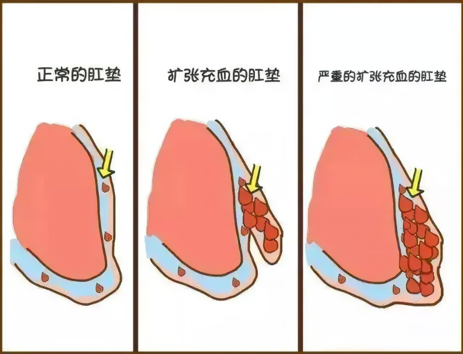 芍倍注射后痔疮脱落图片