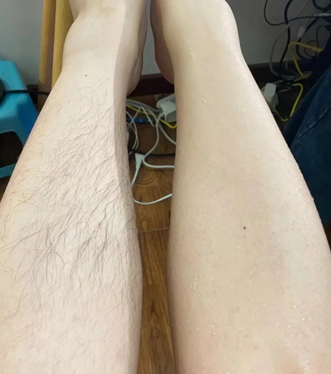 想要拥有光滑细腻的腿部肌肤,永久去除腿毛是一个不错的选择.