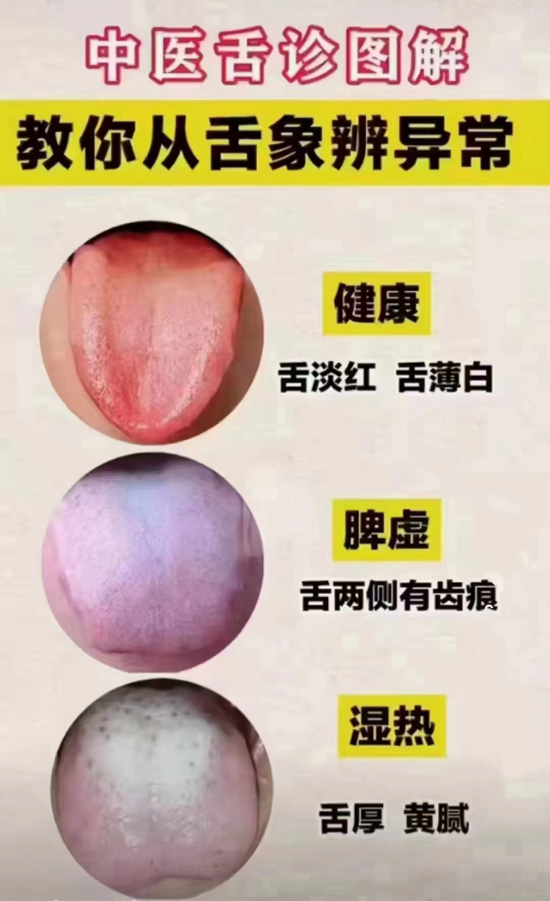 舌苔# #中医舌苔# #脾胃专家王碧辉主任
