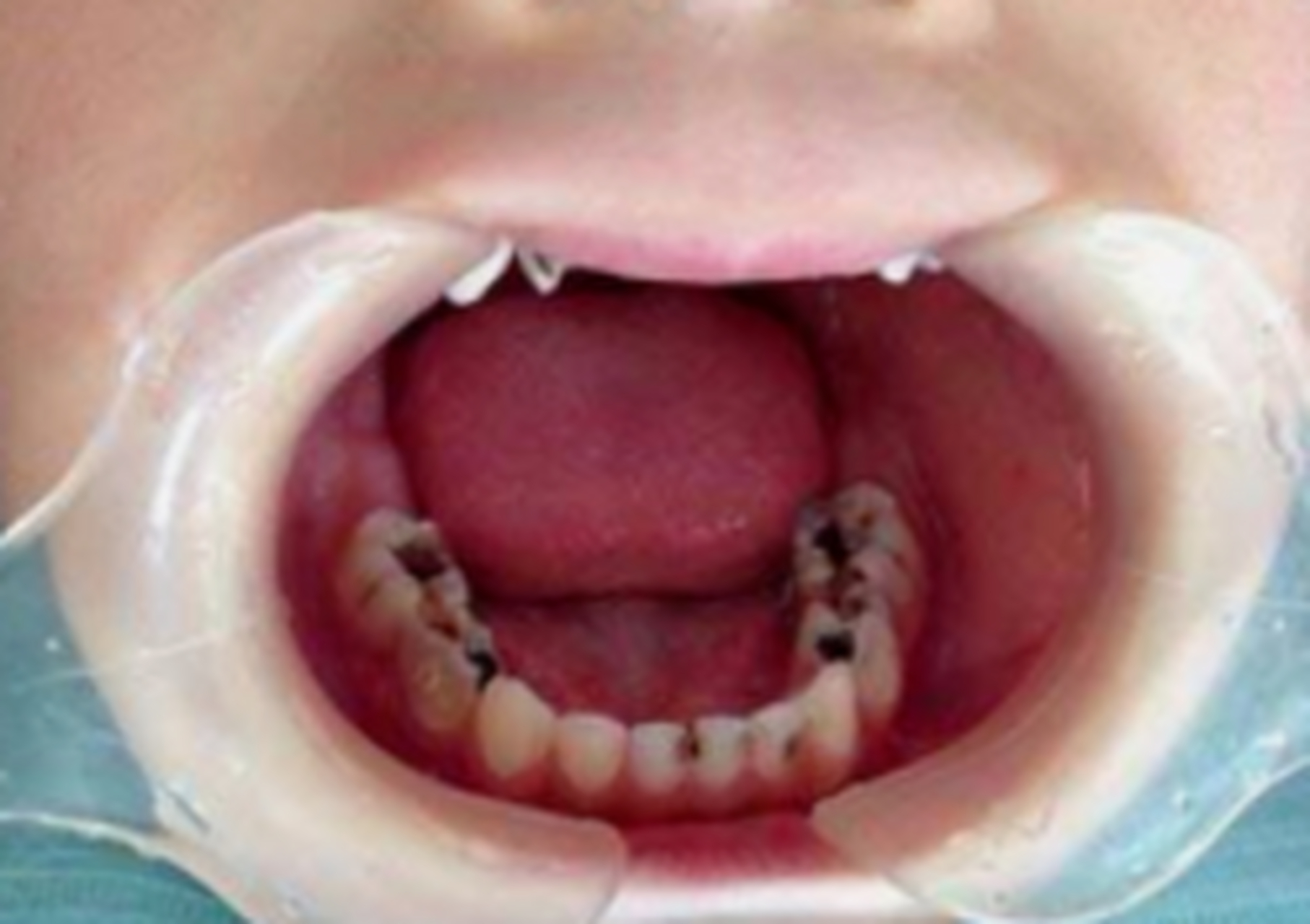 因为这很有说明你已经开始蛀牙,前期浅龋牙釉质被