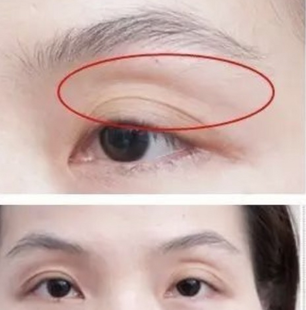 眼窝凹陷是一种常见的美容问题,而自体脂肪移植可以作为一种方法来