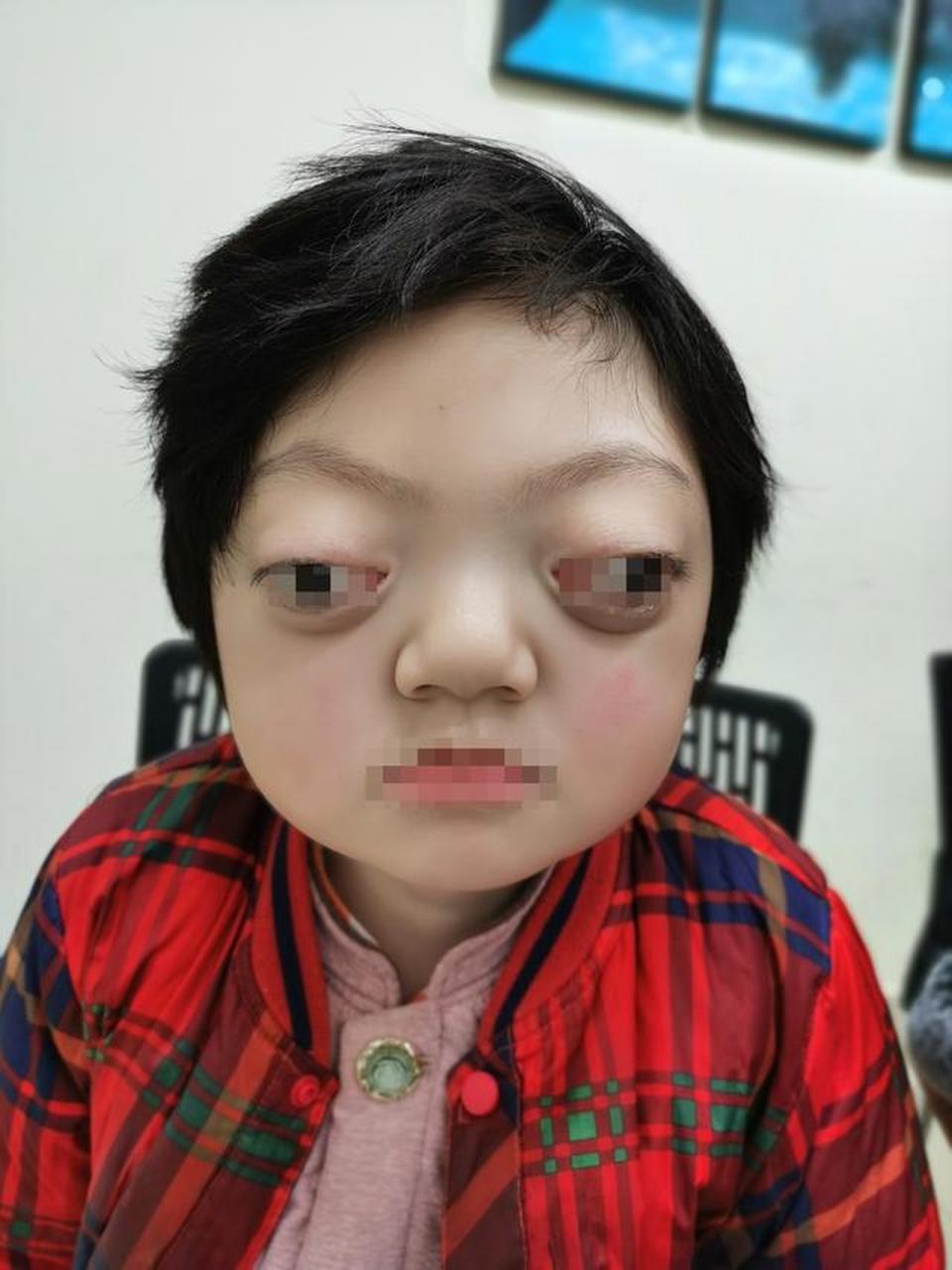 九院韦敏教授,又一例crouzon综合征患儿,终于住院等待手术了,手术一定