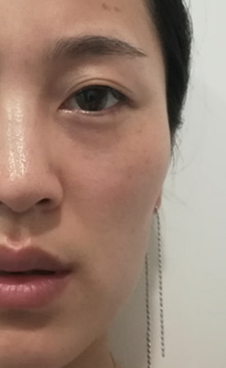 脸颊凹陷怎么办?