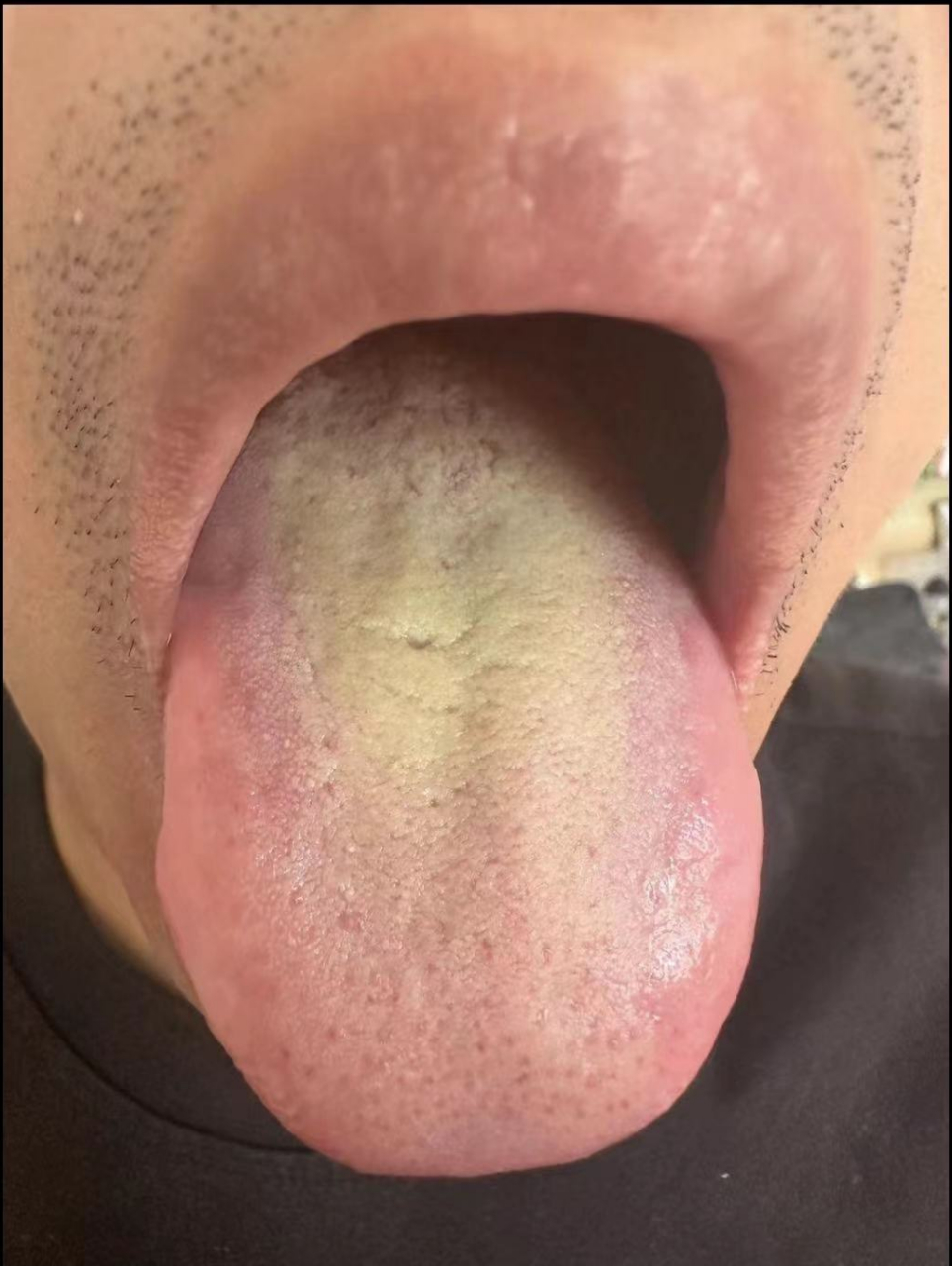 舌面有瘀点存在,瘀点是体内淤血内生的反应  2,舌中舌苔厚腻,发黄,很
