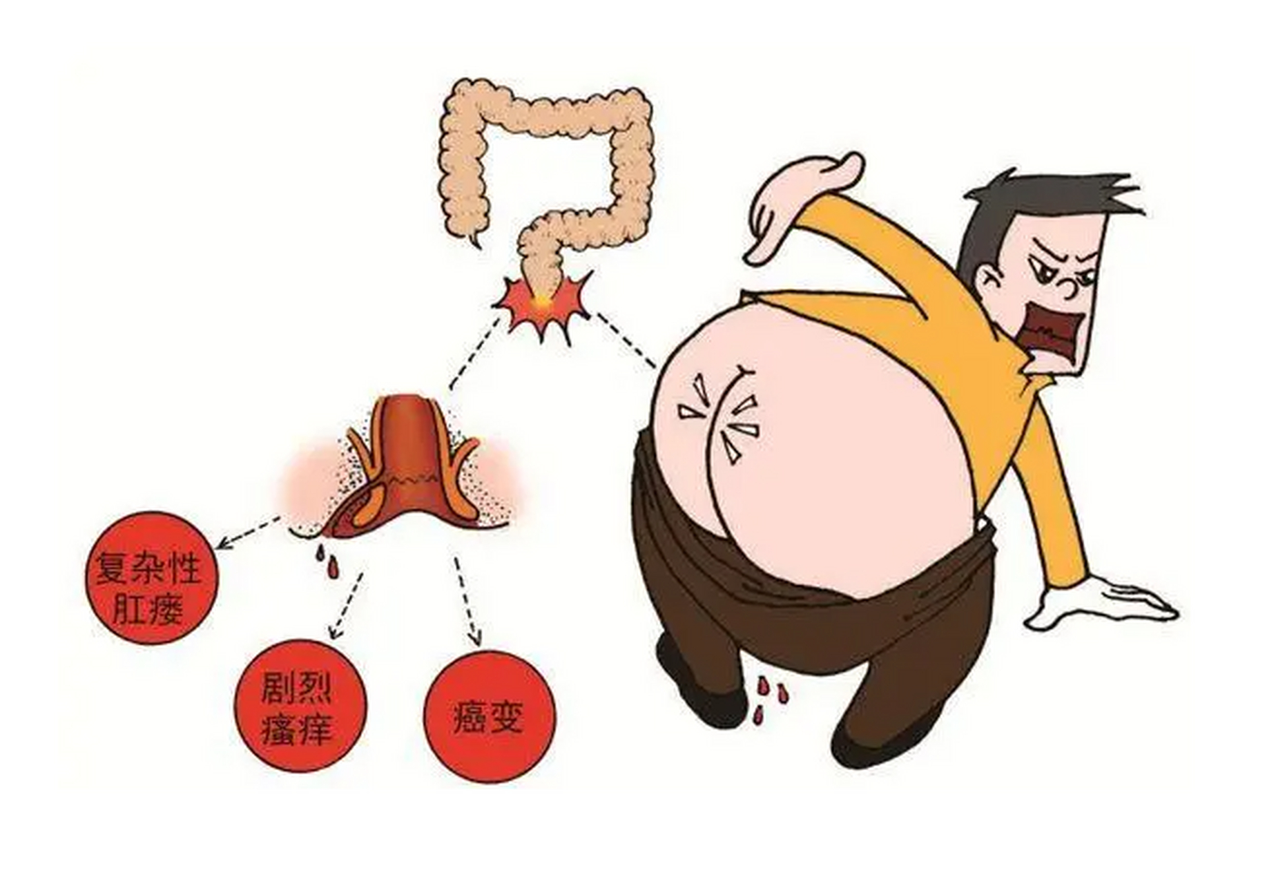 复杂性肛瘘是一种比较严重的肛瘘类型,通常与其他疾病或情况有关.