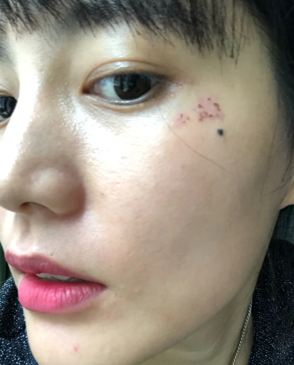 光子嫩肤反黑多久退掉 #医美科普挑战赛#  光子嫩肤是一种非常受欢迎