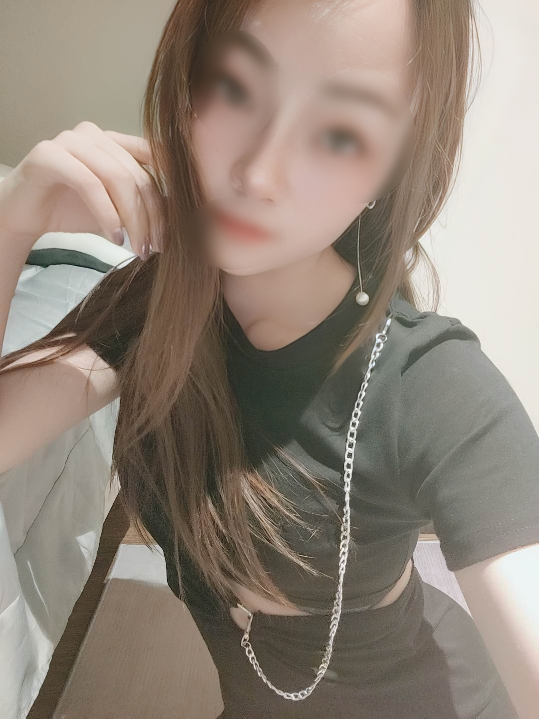 方案设计耳软骨假体 鼻综合  术后反馈参加聚会还