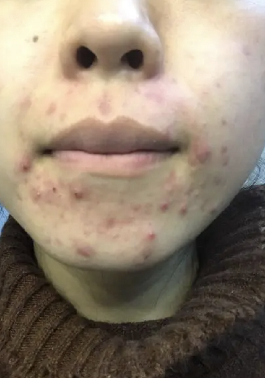 红蓝光祛痘# 脸上长痘痘的原因是什么 经常长痘痘的原因有很多,主要