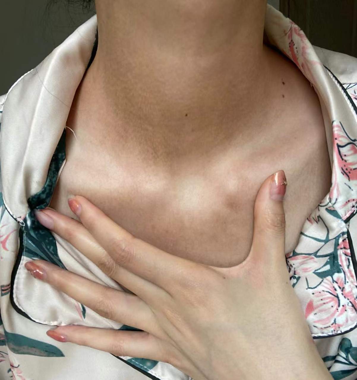 脖子上有咖啡斑怎么办?