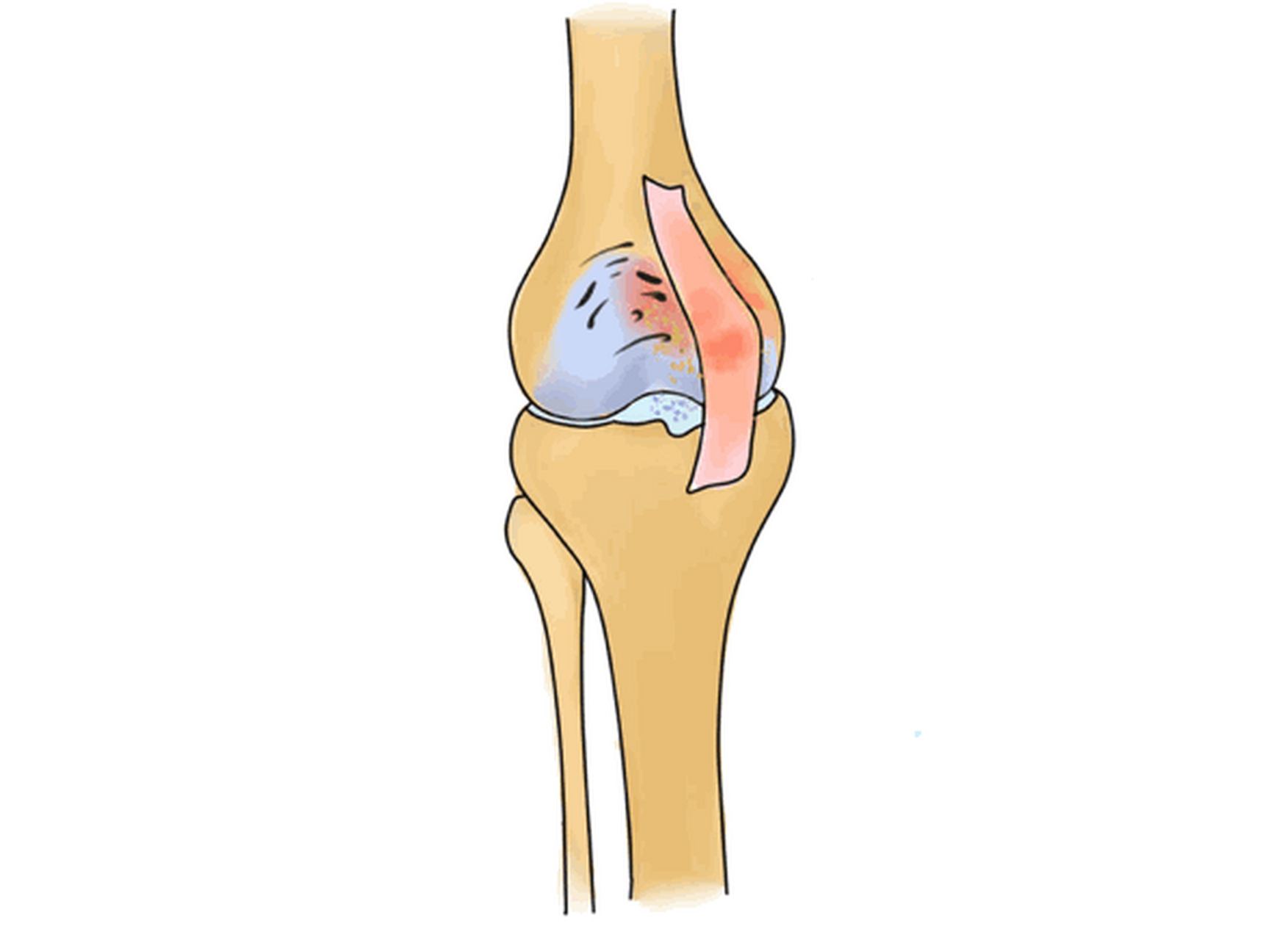 膝关节骨性关节炎卡通图片