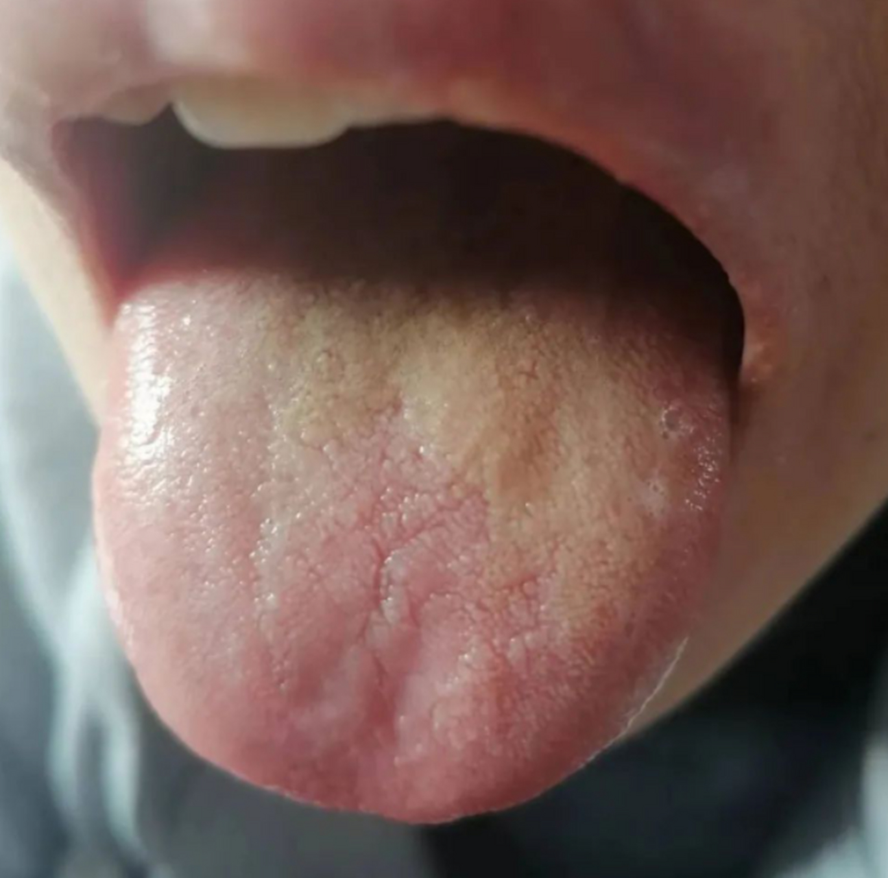 这个舌像舌前红无苔,舌中苔黄厚腻,舌体胖大