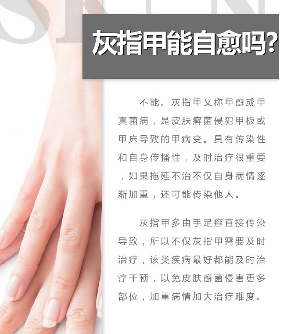 灰指甲又称甲癬或甲真菌病,是皮肤癣菌侵犯甲板或甲床导致的甲病变.