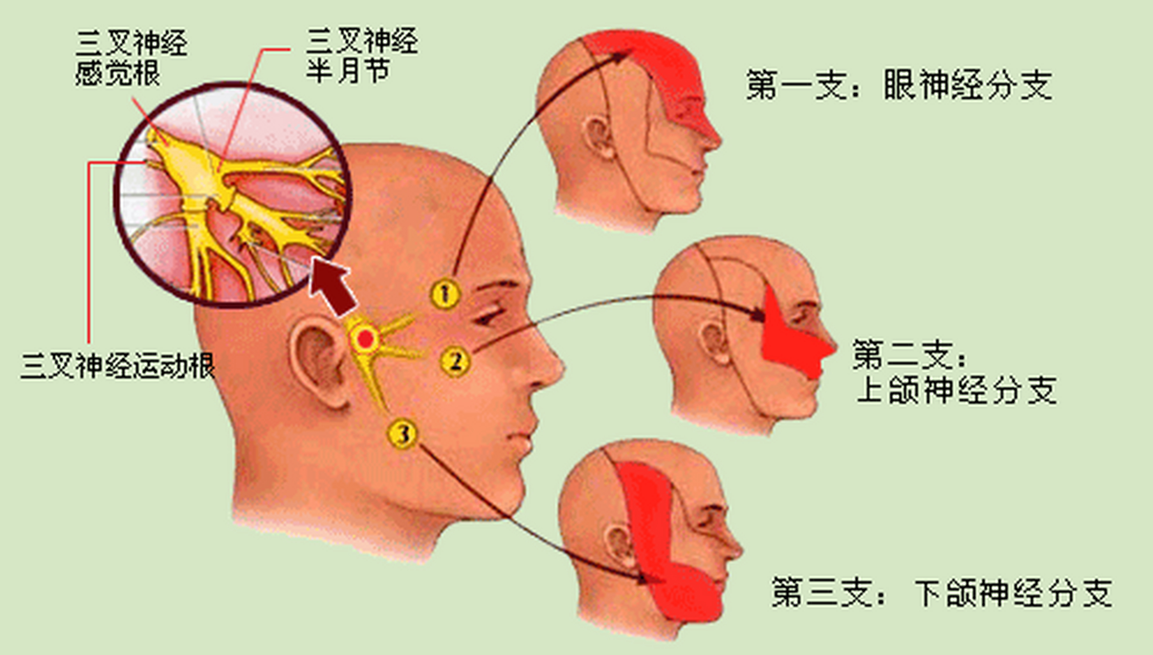 三叉神經痛有多痛?