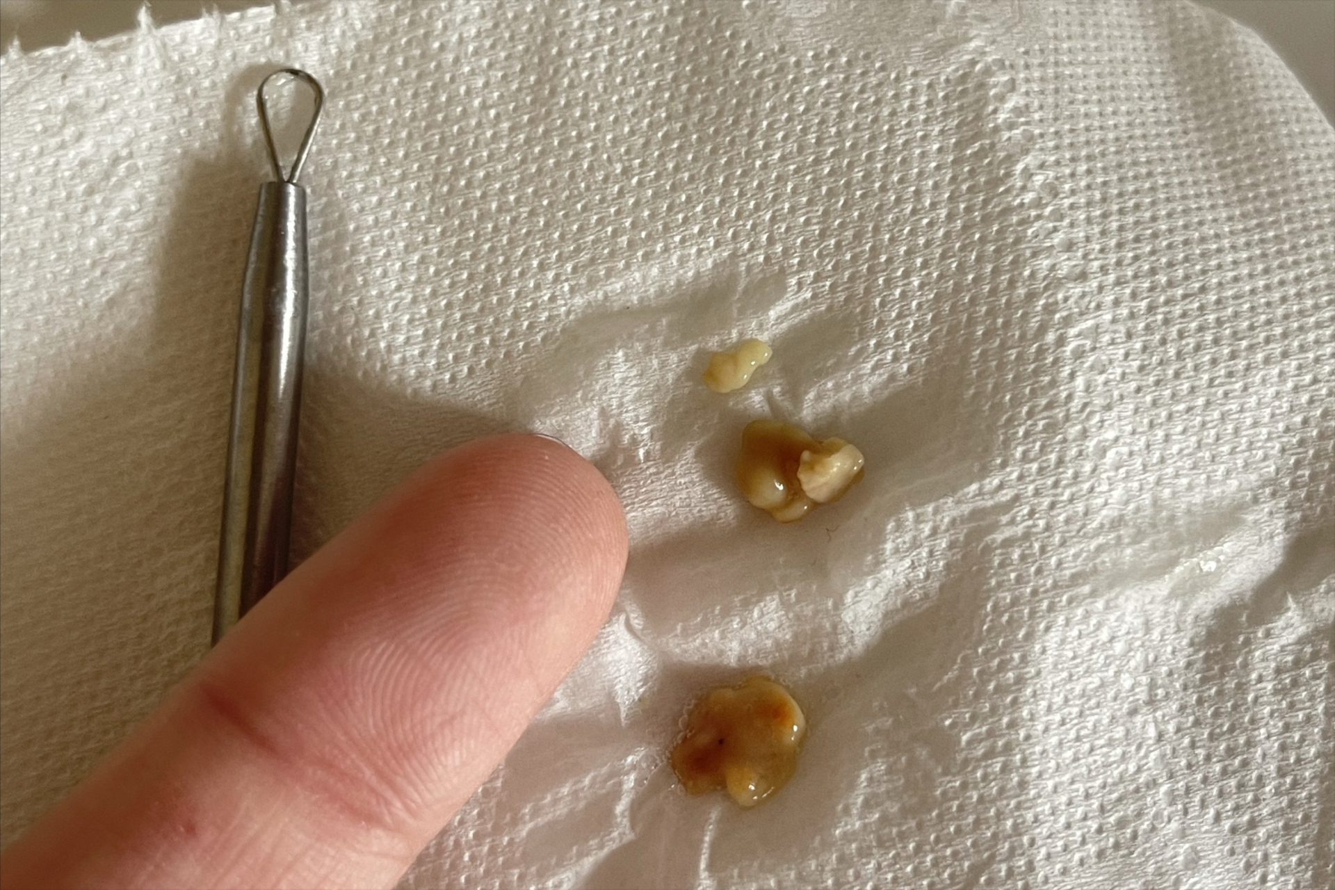 来医院检查,医生从他的舌头下拔出了一块豆大的石头.