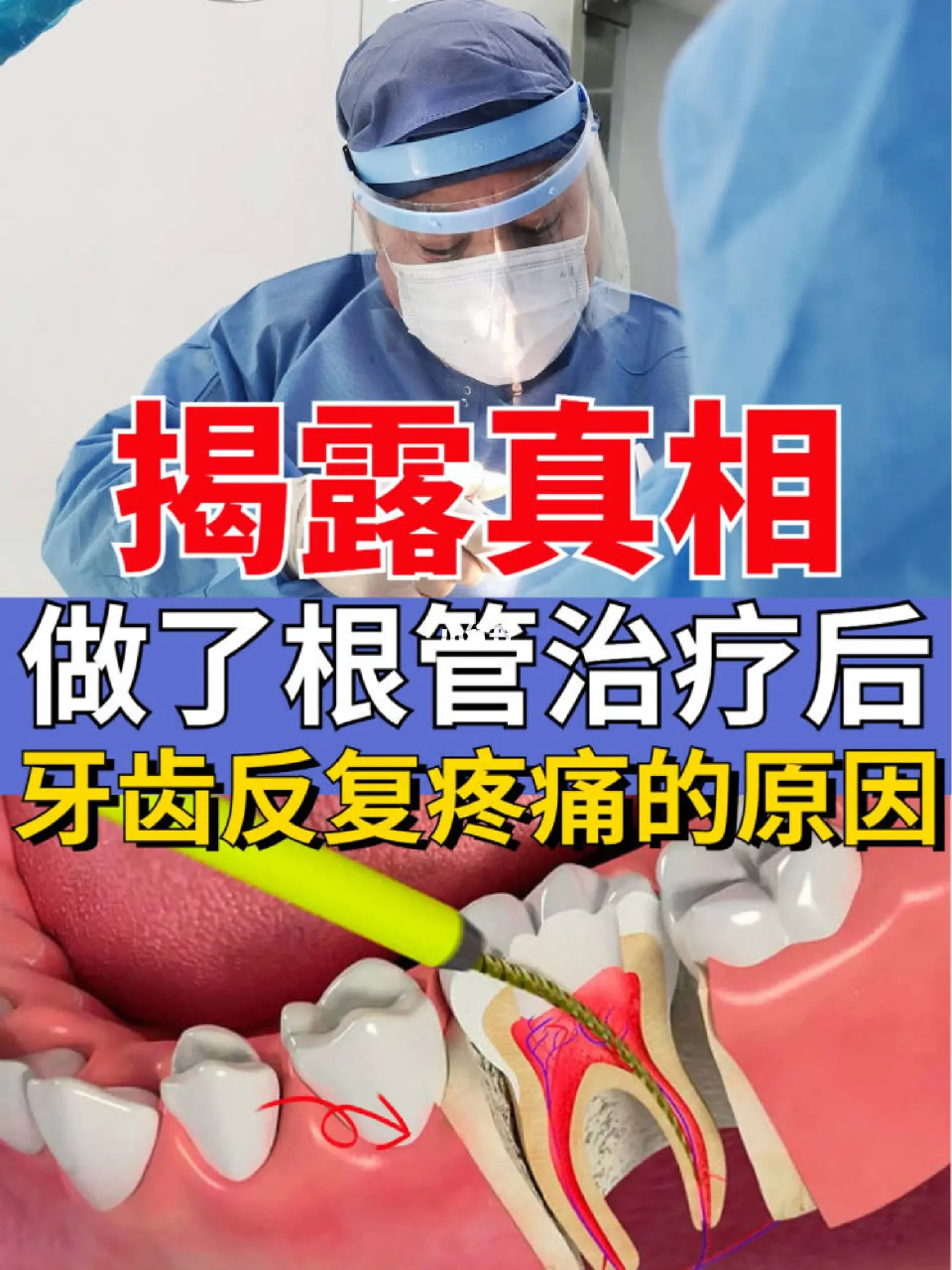 揭露真相:做了根管治疗后牙齿反复疼痛的原因   很多人说根管治疗后我