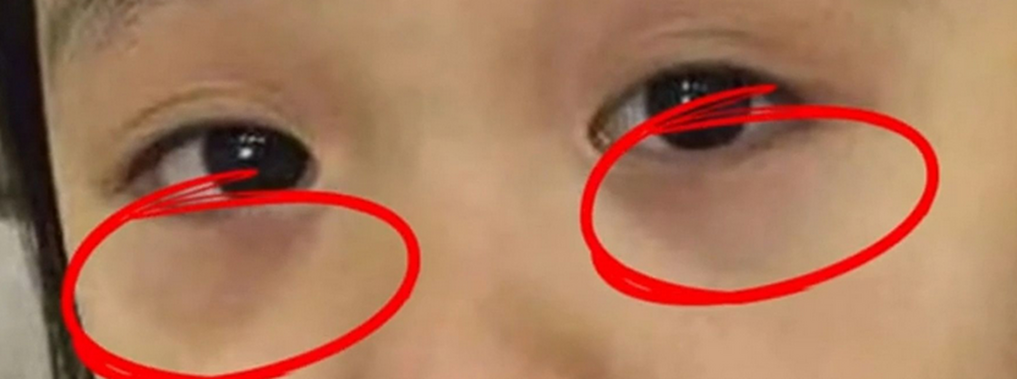 孩子面色蜡黄,浓浓的大眼袋,经常性咳嗽,多痰,到底是什么地方出了问题