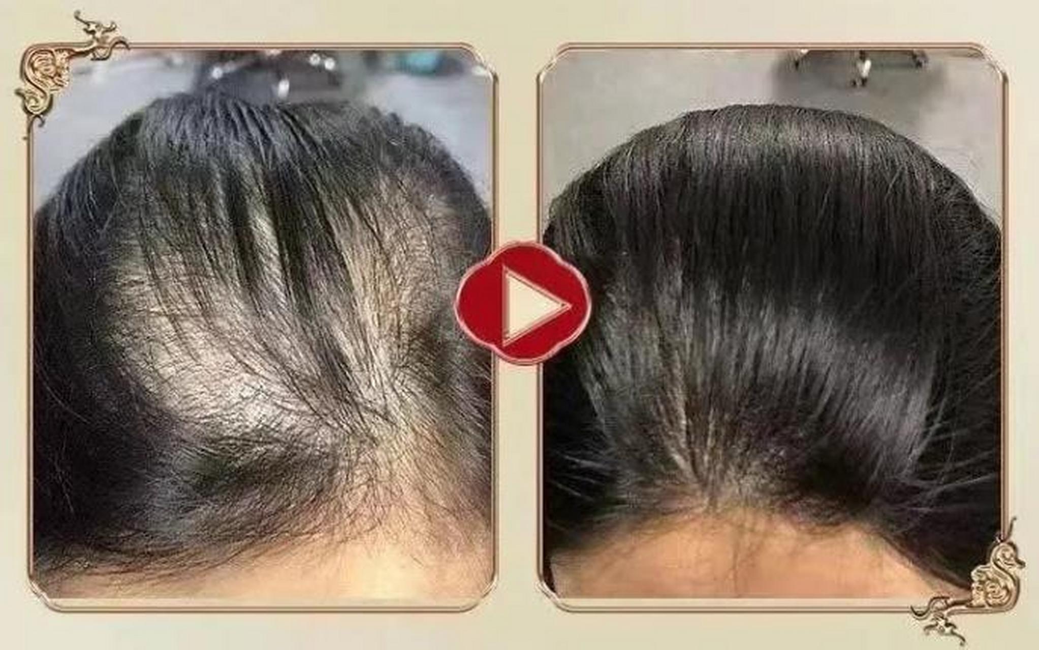 女生掉头发用什么好?