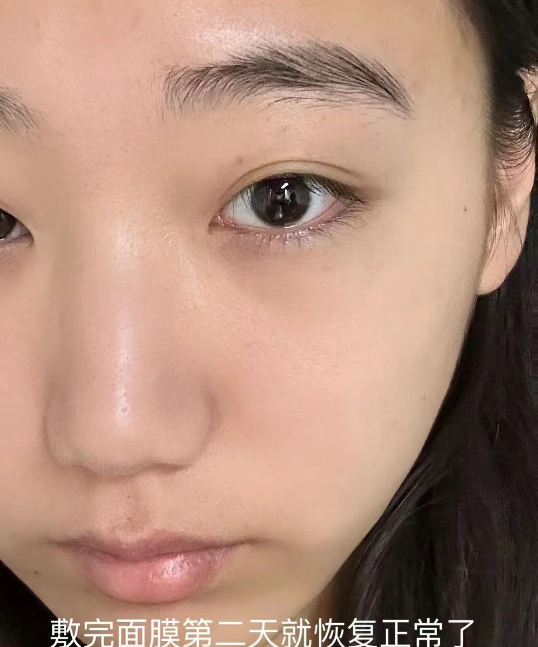 还有陈旧的痘印脸上出油还多毛孔也是格外的粗大所以就决定做来了